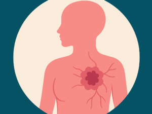 Enfermería Oncológica y Atención Psicosocial en el Cáncer de Mama Metastásico (mBC)