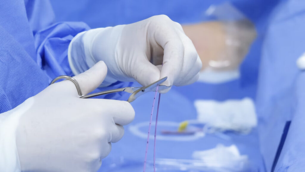 Catéteres vasculares en la terapia oncológica