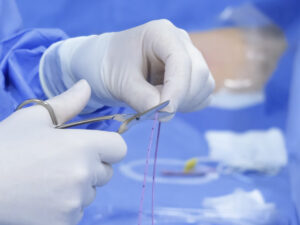 Catéteres vasculares en la terapia oncológica